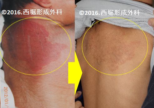 毛細血管奇形（単純性血管腫） | あざ治療の専門クリニック｜西堀形成外科