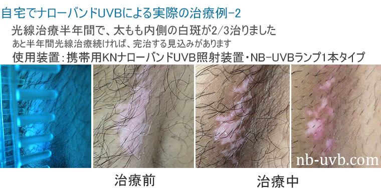 家庭用ナローバンドUVB(311)/エキシマ(308)紫外線治療器[個人輸入