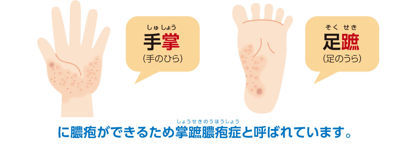 掌蹠膿疱症とは | 掌蹠膿疱症でスキリージ®を使用される方へ